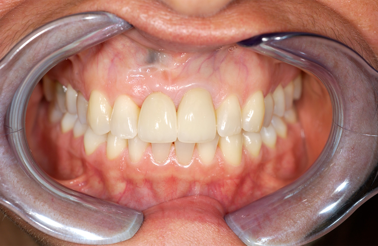 3. Ergebnis – Krone auf einem Implantat und ein Veneer auf dem Nachbarzahn